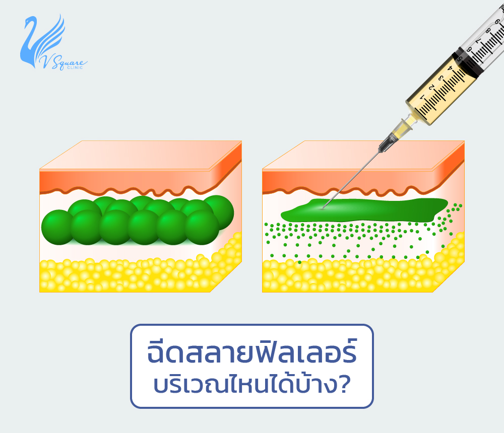 ฉีดสลายฟิลเลอร์ จมูก ปาก ใต้ตา อันตรายไหม กี่วันหาย ราคาเท่าไหร่