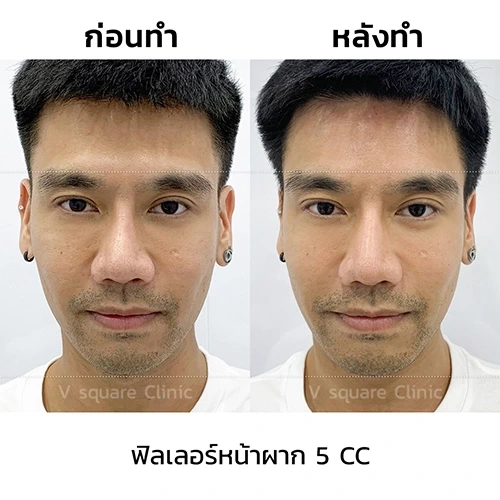 ร้อยไหมหน้าผากคืออะไร ? อันตรายไหม? ทำไมถึงไม่ค่อยได้รับความนิยม