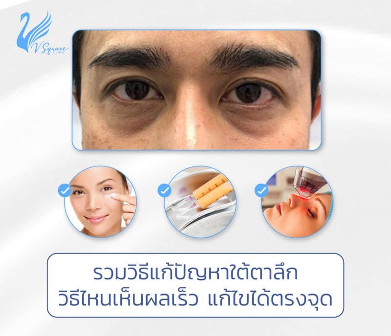 รู้สาเหตุปัญหา ใต้ตาลึกคล้ำ ขอบตาลึก เกิดจากอะไร พร้อมวิธีแก้ไขที่เหมาะสม